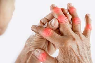 Artrose nos Dedos