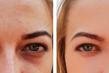 blefaroplastia antes e depois