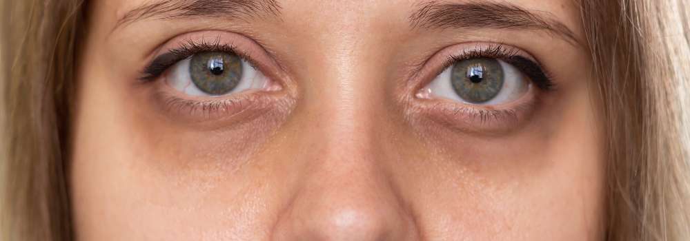 Olheiras Profundas: Tratamentos Eficazes Para Rejuvenescer - Cidade Viva