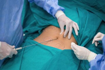 Preço da Lipoaspiração em Portugal: Fatores e O que Inclui