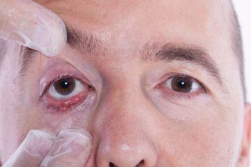 Tratamentos Eficazes para Aliviar e Prevenir Terçolhos